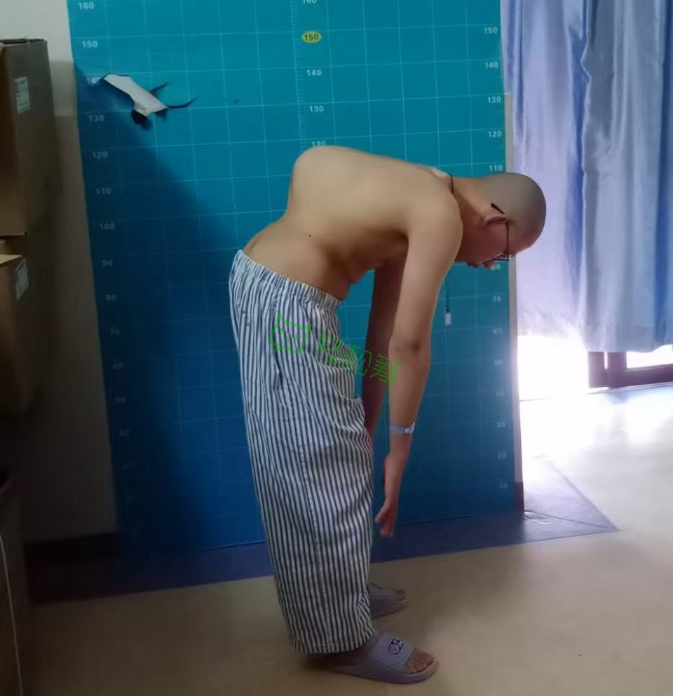 爱心求援：19 岁在读高二学生， 脊柱畸形少年命悬一线，期待你的善意，帮他挺过难关